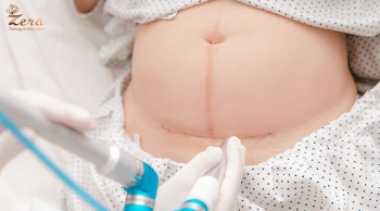 Sau khi mổ, mẹ nên có chế độ dinh dưỡng như thế nào?